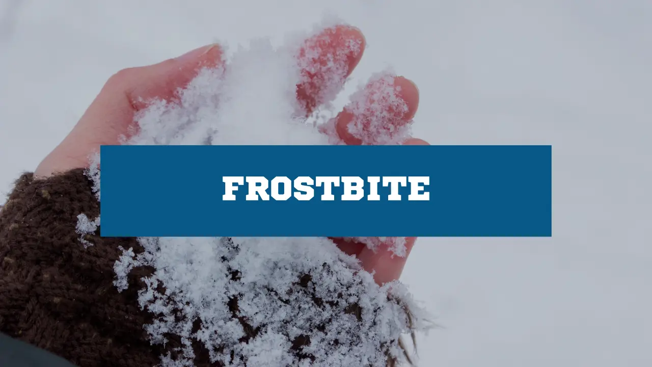 Frostbite First Aid Guide Causes, Symptoms, and Treatment